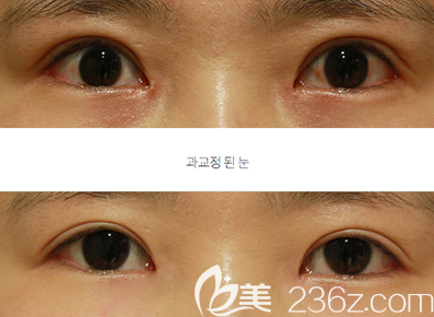 韩国右手整形外科金英民双眼皮修复案例效果对比图