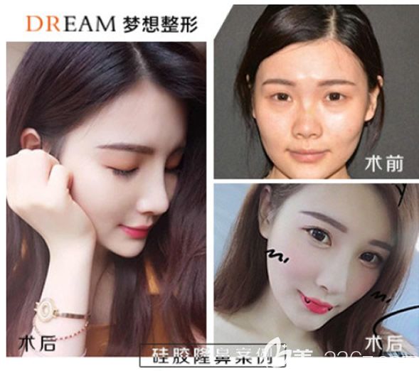 兰州时光相伴赵美霞医生硅胶假体隆鼻 兰州时光相伴赵美霞医生硅胶假体隆鼻