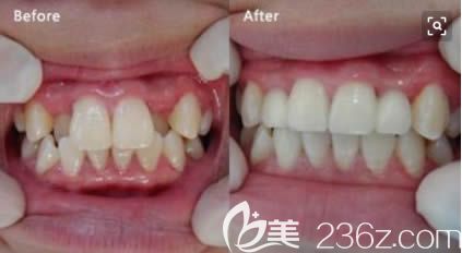 重庆维乐周姣医生青少年牙齿拥挤矫正前后对比效果 重庆维乐周姣医生青少年牙齿拥挤矫正前后对比效果