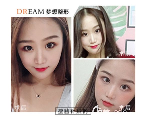 兰州梦想陈元捷隆鼻 兰州梦想陈元捷隆鼻