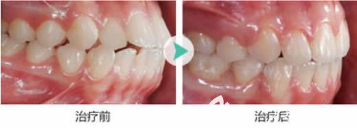 重庆维乐口腔周姣医生28岁矫正牙齿前后对比照 重庆维乐口腔周姣医生28岁矫正牙齿前后对比照