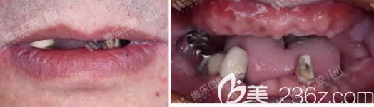 60岁老人在重庆维乐口腔做种植牙术前照