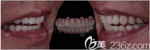 让刘继洪医生做完全口种植牙后的照片