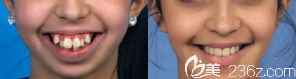 重庆维乐口腔青少年虎牙矫正前后对比效果 重庆维乐口腔青少年虎牙矫正前后对比效果