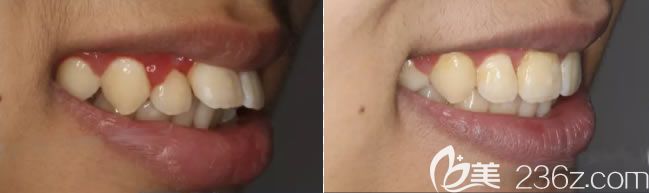 重庆维乐口腔杨国平医生青少年深覆盖矫正前后对比照 重庆维乐口腔杨国平医生青少年深覆盖矫正前后对比照