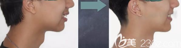 深覆盖矫正后脸型变化图 深覆盖矫正后脸型变化图