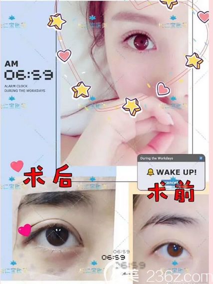 呼市五洲杨仁宝做双眼皮修复效果怎么样 呼市五洲杨仁宝做双眼皮修复效果怎么样