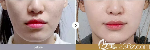 韩国ID热玛吉真人案例效果对比图 韩国ID热玛吉真人案例效果对比图