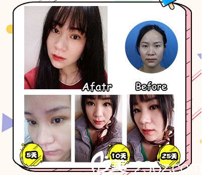 广州军美医美产慎之双眼皮案例