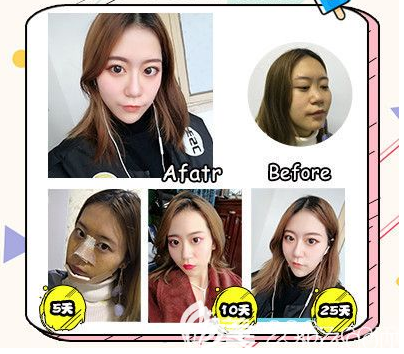 广州军美医美产慎之隆鼻手术案例