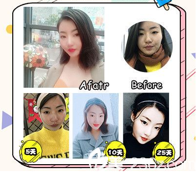 广州军美产慎之医生线雕提升案例