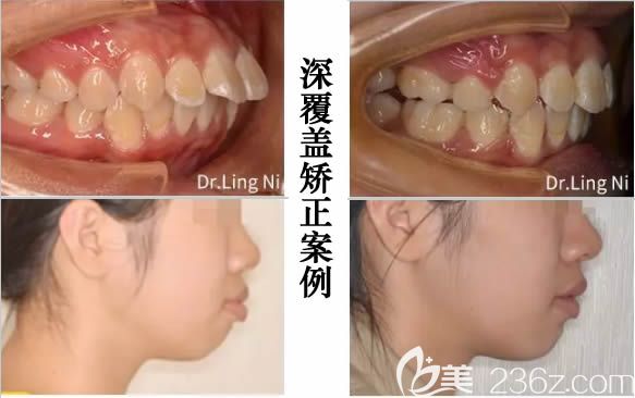 重庆维乐口腔成人深覆盖牙齿矫正案例效果图 重庆维乐口腔成人深覆盖牙齿矫正案例效果图