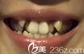 我在郑州拜博口腔做虎牙矫正前的照片 我在郑州拜博口腔做虎牙矫正前的照片