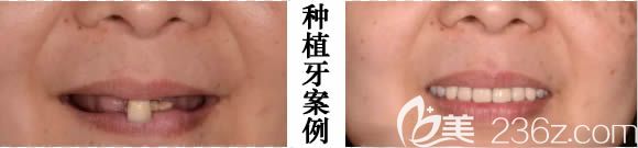 重庆维乐口腔全口数字化种植牙前后对比效果图 重庆维乐口腔全口数字化种植牙前后对比效果图