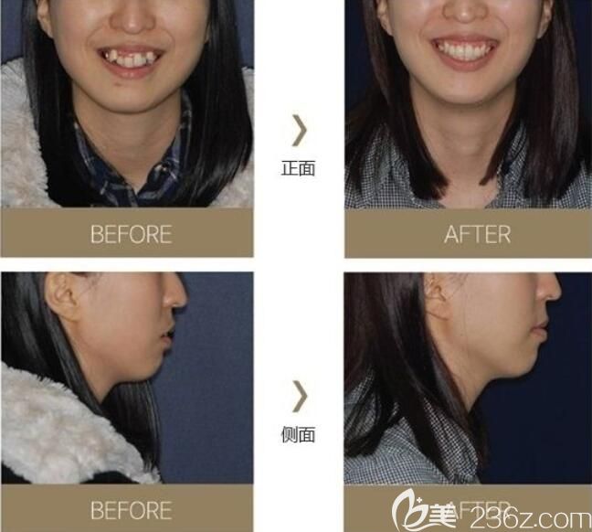 韩国首尔椰美coconut牙科医院牙齿矫正案例