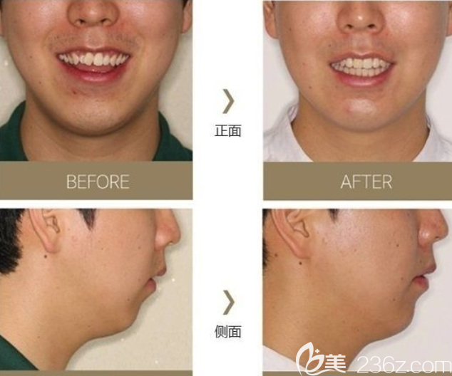 牙齿矫正 牙齿矫正