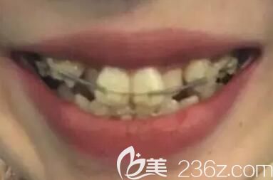 我在郑州拜博口腔做牙齿矫正第3个月