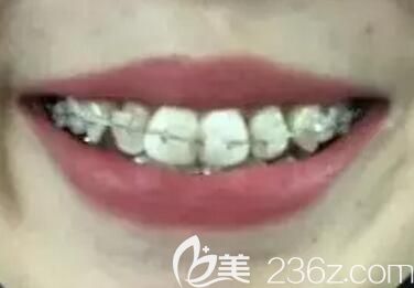 我在拜博口腔做陶瓷托槽牙齿矫正第9个月 我在拜博口腔做陶瓷托槽牙齿矫正第9个月