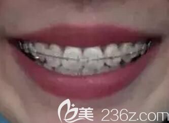 我在郑州拜博口腔做牙齿矫正第12个月 我在郑州拜博口腔做牙齿矫正第12个月