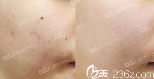 韩国CDU清潭优美肤案例 韩国CDU清潭优美肤案例