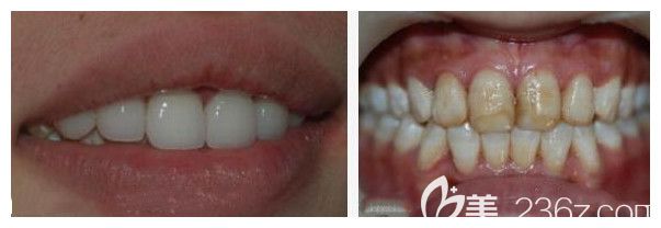 莫三心主任氟斑牙美容修复案例