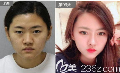 淄博美联臣整形医院双眼皮案例