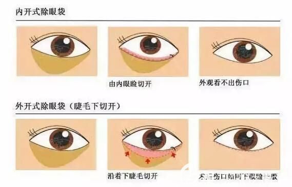 郑宇医生分享去眼袋的两种方法原理