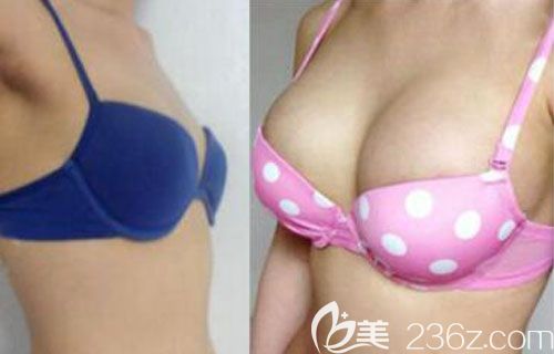 韩国丽珍假体隆胸案例前后效果对比图