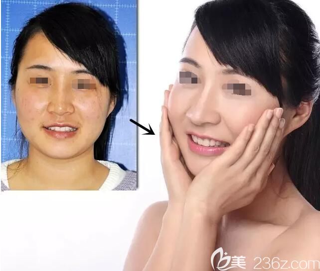 同事到无锡爱思特祛斑前后对比案例 同事到无锡爱思特祛斑前后对比案例