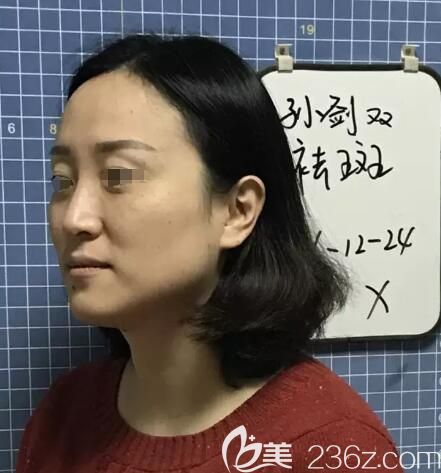 面诊范红梅医生术前脸上斑点明显 面诊范红梅医生术前脸上斑点明显