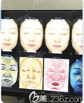 检测出来的面部斑点问题 检测出来的面部斑点问题