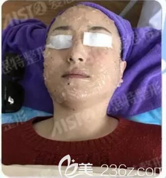 大Q祛斑术前面部涂抹麻醉膏 大Q祛斑术前面部涂抹麻醉膏