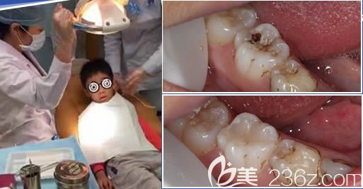 广州圣贝口腔杨妙芬龋齿填充效果对比图 广州圣贝口腔杨妙芬龋齿填充效果对比图