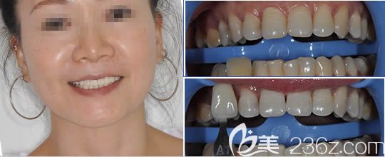 广州圣贝口腔杨妙芬冷光美白效果对比图 广州圣贝口腔杨妙芬冷光美白效果对比图