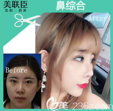 淄博美联臣整形医院鼻综合案例 淄博美联臣整形医院鼻综合案例