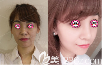 医美王小东医生假体隆鼻案例