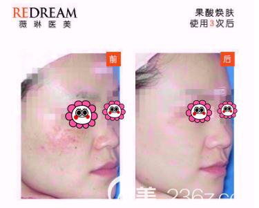 刘丽医生果酸焕肤案例