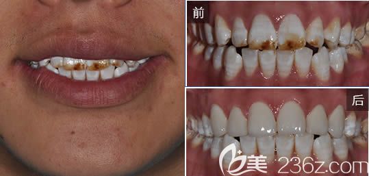 广州圣贝口腔赵艳明牙齿贴面效果对比 广州圣贝口腔赵艳明牙齿贴面效果对比