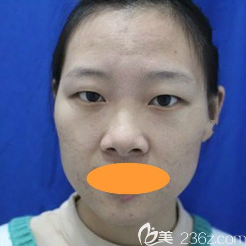 2年前做的埋线双眼皮消失后的样子 2年前做的埋线双眼皮消失后的样子