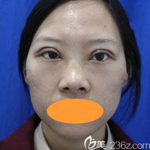 西宁时光医院薛院长给我做全切7mm双眼皮术后第1天 西宁时光医院薛院长给我做全切7mm双眼皮术后第1天