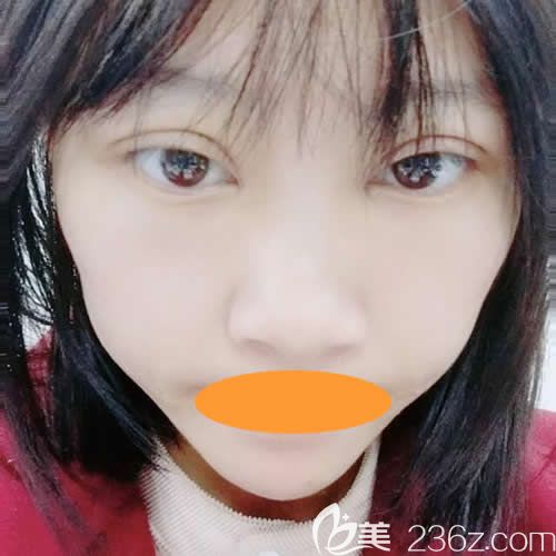 西宁时光医院薛院长给我做全切双眼皮术后第7天 西宁时光医院薛院长给我做全切双眼皮术后第7天