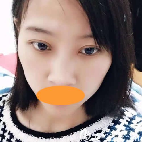 西宁时光医院薛院长给我做全切7mm双眼皮术后第21天 西宁时光医院薛院长给我做全切7mm双眼皮术后第21天