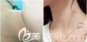 上海愉悦美联臣医疗美容医院嗨体去颈纹真人案例对比图
