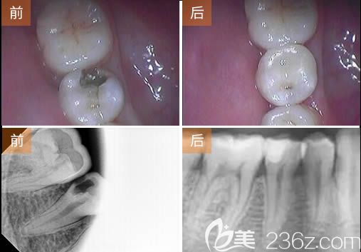 广州圣贝口腔张婉瑜根管治疗牙髓病案例效果图