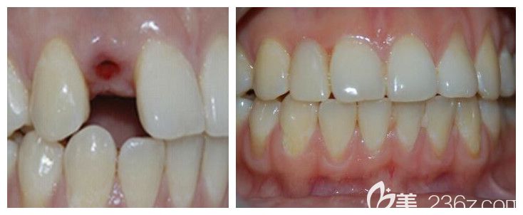 徐雅轩医生单颗牙种植案例