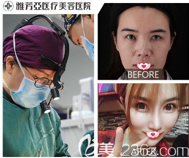 雅芳亚整形医院做自体软骨隆鼻案例