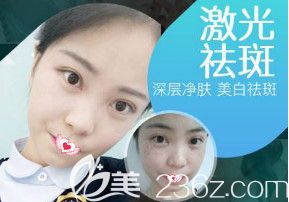 石家庄雅芳亚做激光祛斑案例