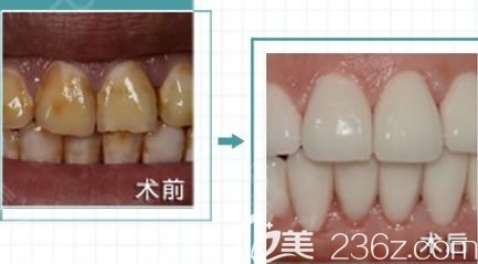 牙齿发黄选择全瓷牙修复案例效果图
