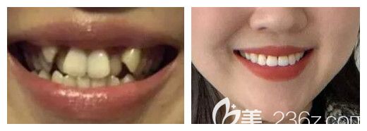 郑州拜博口腔马贺博士正畸案例