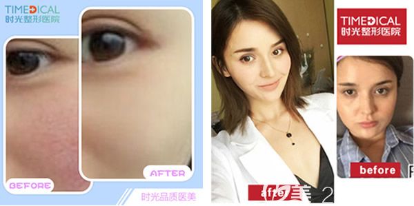 兰州时光整形医院激光去红血丝+注射瘦脸效果案例 兰州时光整形医院激光去红血丝+注射瘦脸效果案例